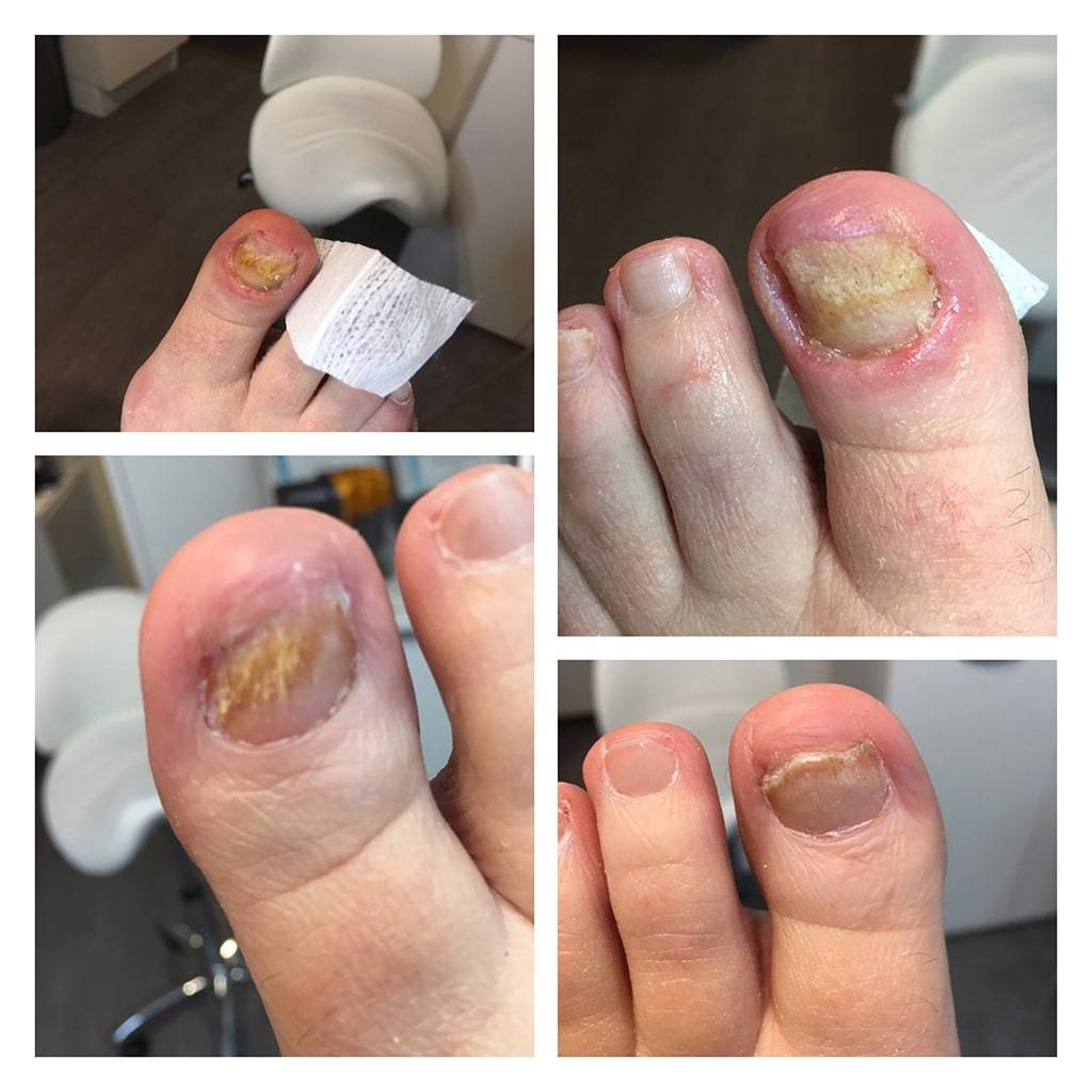 schimmel-nagels-klein