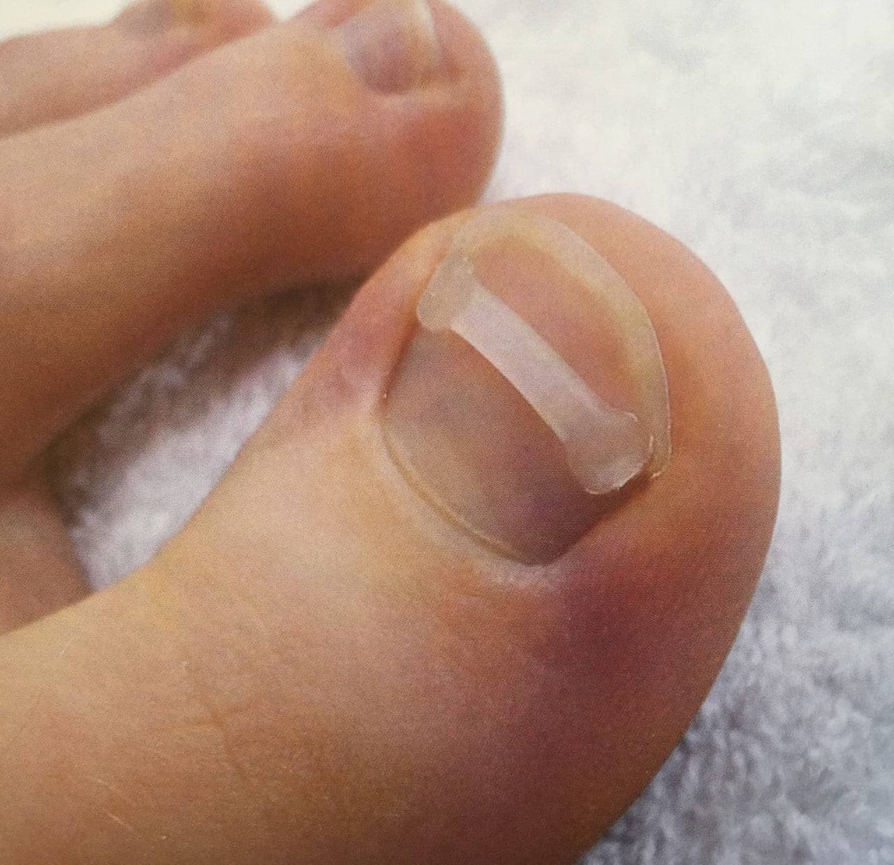 Nagelbeugel van camathe in neede