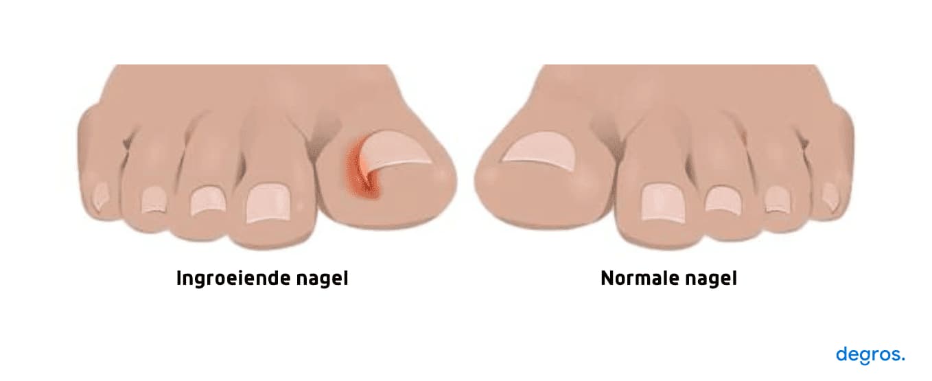 oorzaken-ingroeiende-nagel